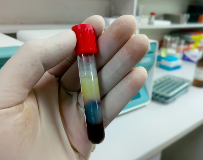 科学家持有血脂血样，高甘油三酯含有血清样本。脂血