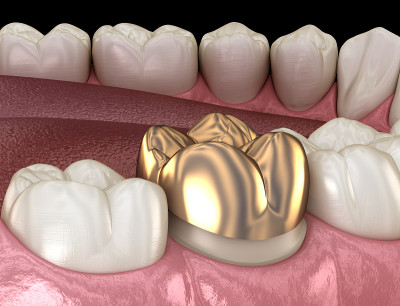金冠磨牙装配工艺。医学上精确的人类牙齿治疗的3D插图