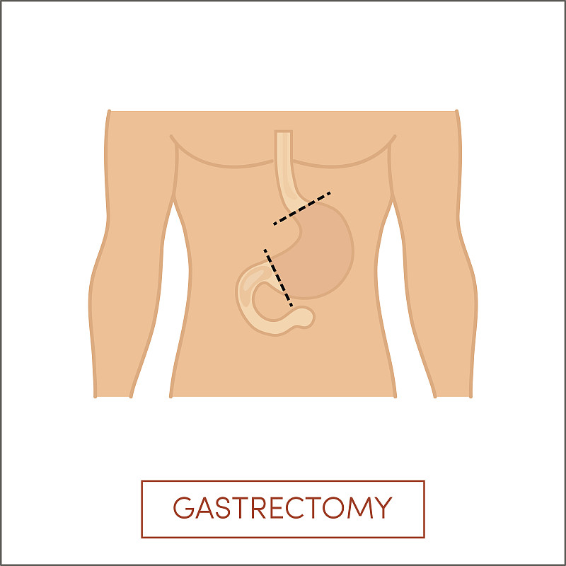 胃切除术向量