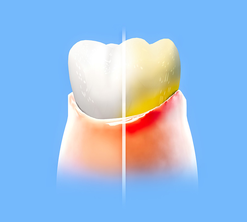 牙齿，牙龈发炎，发红，牙科，牙齿清洁，口腔卫生。