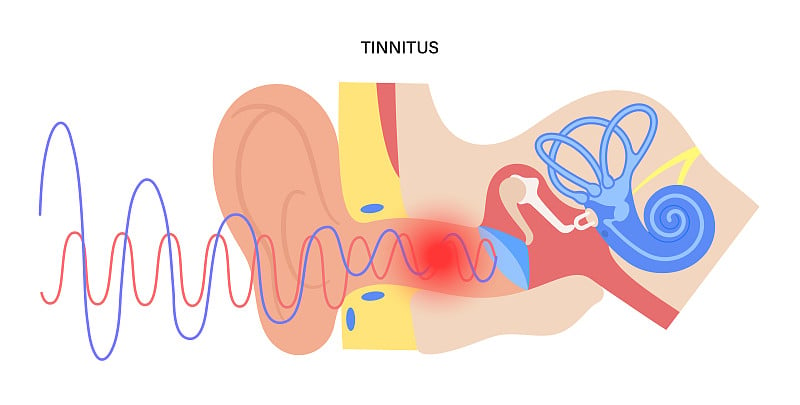 耳鸣疾病的概念