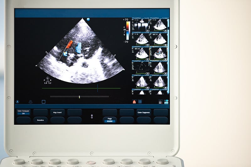 一个带心脏扫描的超声波设备屏幕。多普勒方法显示瓣膜返流。