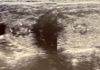 甲状腺结节超声检查