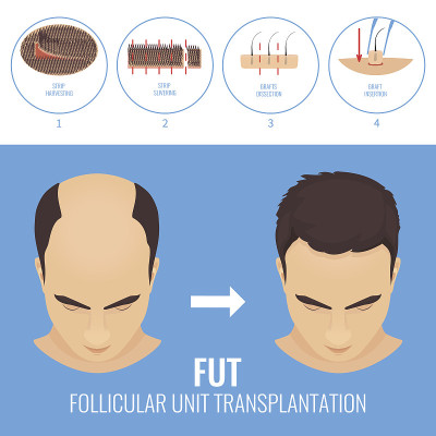 FUT治疗男性