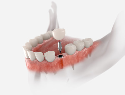 Premolar tooth implant