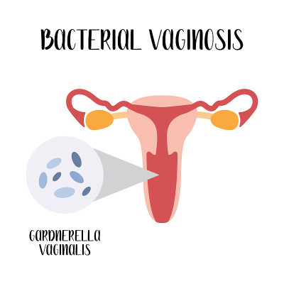 细菌性阴道炎。加德纳菌属游民і向图书馆。细菌性阴道病。女性生殖系统。妇科。矢量平面卡通插图