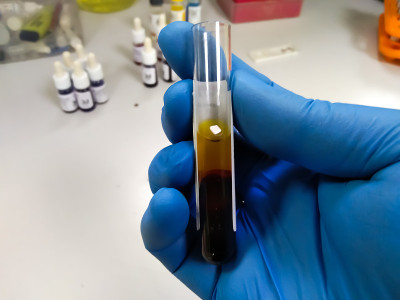 科学家手持高胆红素血症血清血液样管进行胆红素试验。
