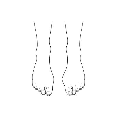 Hallux valgus, bunion.