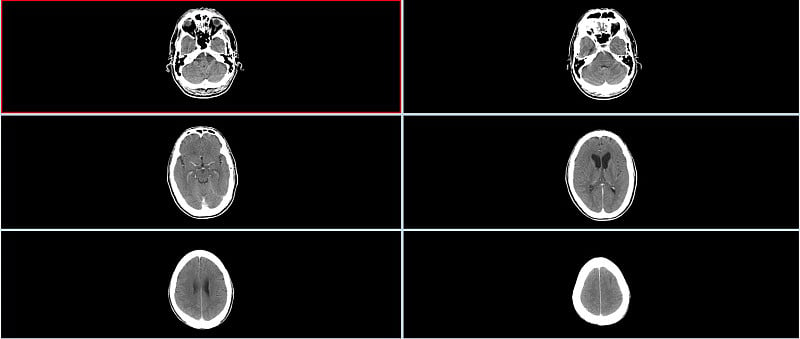 脑CT扫描(头部计算机断层扫描)高分辨率