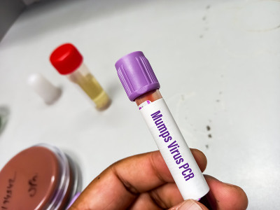 分子生物学家保存腮腺炎病毒PCR检测的血液样本。实验室的背景
