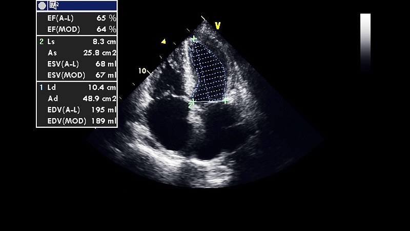 经食管超声检查心脏图像。