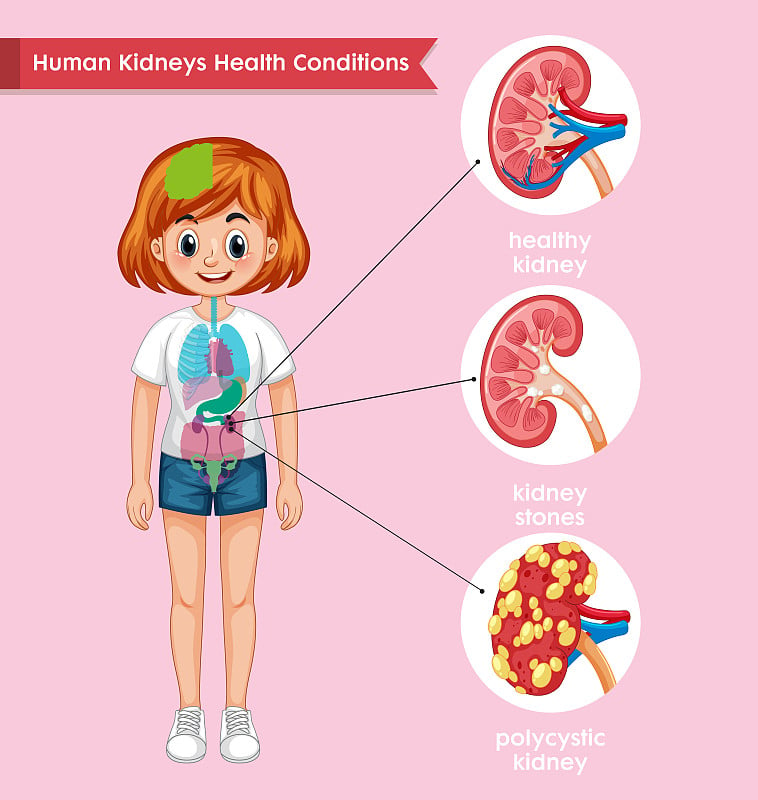肾脏疾病的科学医学说明