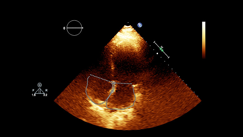 经食管超声检查心脏图像。