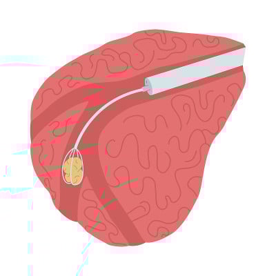 从唾液腺取出结石的内窥镜手术的矢量插图。Sialendoscopy