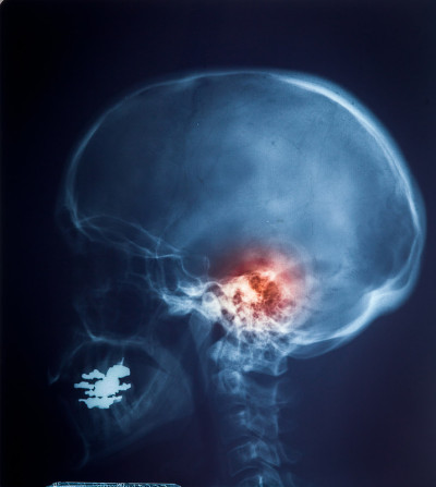 脊柱、颈部和头部应力的X线MRI