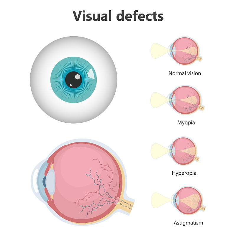 眼睛的缺陷
