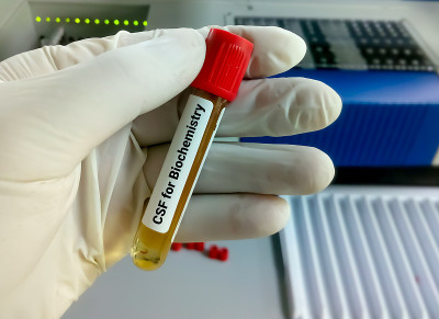 生化学师保存脑脊液样本作生化检查，包括葡萄糖、蛋白质、ADA