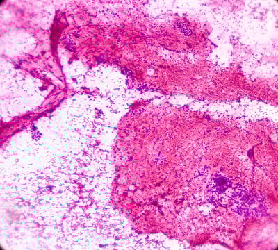 胰腺肿块(CT引导FNA):恶性细胞、腺癌、非典型上皮细胞阳性