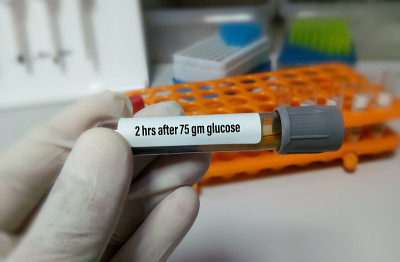 在服用75克葡萄糖2小时后，科学家或技术人员拿着样管进行血糖测试。诊断高血糖或低血糖。葡萄糖耐量试验