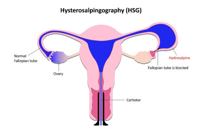 Hysterosalpingography