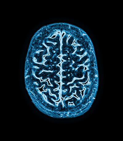 大脑的磁共振成像(MRI)