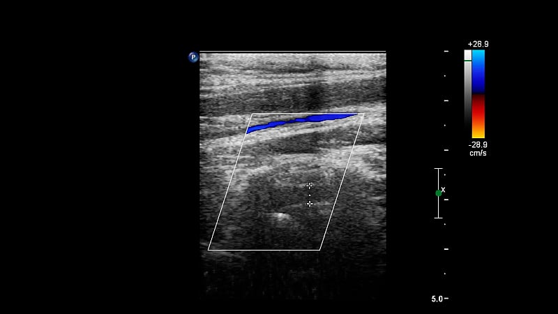 血管超声检查。