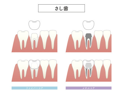 镶齿结构说明