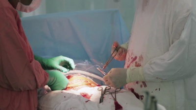 外科医生缝合女人的胃。剖腹产。护士擦手。医疗