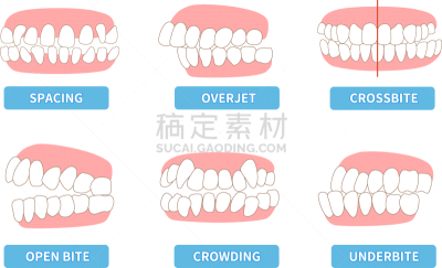 绘画插图,拥挤的,,十字形,闭塞,反差,口腔卫生,不平坦的,横截面,健康保健