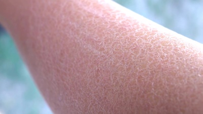 宏图 成年女性手上极度脱水的片状白色皮肤