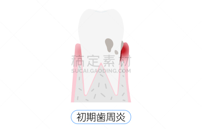 绘画插图,牙周病,早晨,舞台,肿胀的,口腔卫生,健康保健,龋齿,生物膜生物,牙医