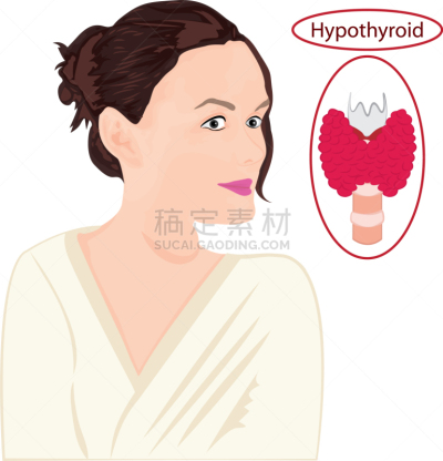 Goiter,内分泌系统,甲状腺,巨大的,碘,健康保健,人,生病