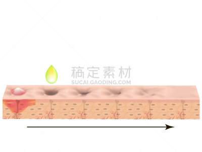 皮肤,矢量,疤,绘画插图,粉刺,萎缩的,解剖模型,分离着色,健康保健,药