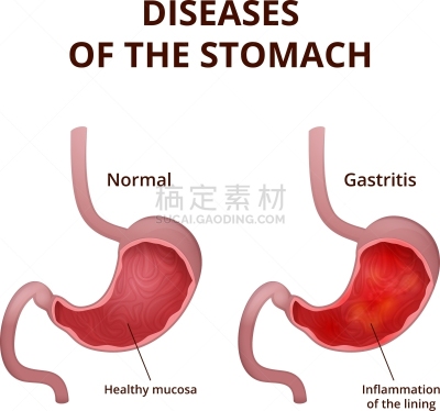 人,生理学,胃,生物学,肠内的,健康保健,图表,食管,图像,生病