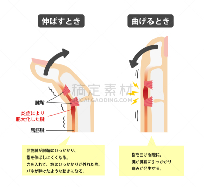 扳机,手指,绘画插图,日本,文字,背景分离,药,坏掉的,手部骨骼