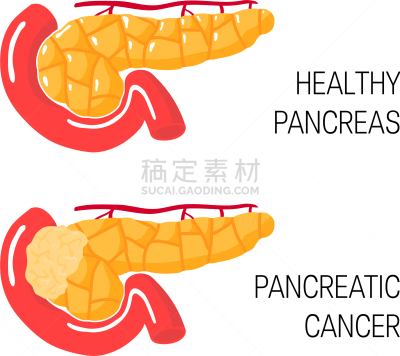 概念,胰腺癌,白色,分离着色,健康保健,人,药,生病