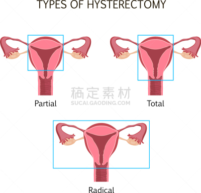 子宫切除术,图表,图像,女人,Endometrial,打字,增生,手术