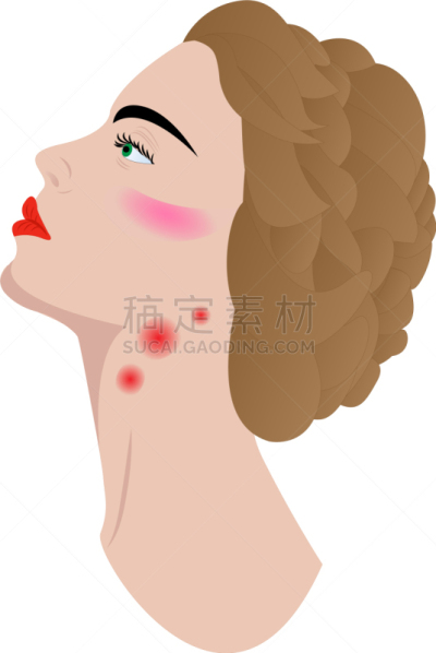 肿胀的,淋巴结,淋巴系统,矢量,白细胞,瘤,图像,生病