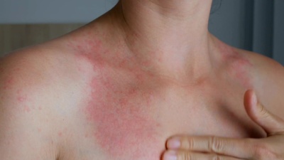 女人用手、脖子抓痒。颈部红斑过敏牛皮癣昆虫叮咬。疟疾。晒伤。晒伤