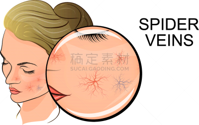 人的脸部,蛛状静脉曲张,女性,健康保健,压力,血栓症,图像,生病,浮肿,手术