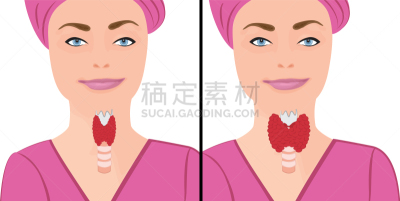 甲状腺,甲状腺机能减退,健康保健,巨大的,人,碘,Goiter,生病