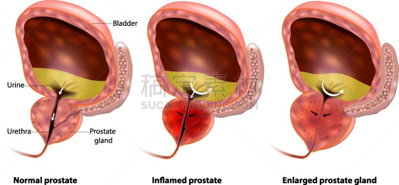 良性的,前列腺,前列腺炎,肥大,健康保健,运河,人类腺体,增生,生长
