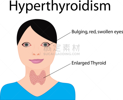 内分泌系统,甲状腺,甲亢,巨大的,喉,人类腺体,下丘脑,人,女人,Goiter
