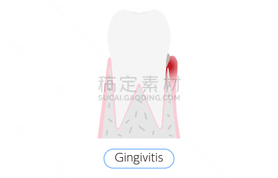 绘画插图,牙周病,齿龈炎,舞台,肿胀的,口腔卫生,健康保健,龋齿,生物膜生物,牙医
