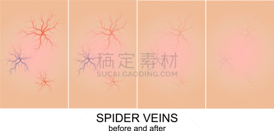皮肤,蛛状静脉曲张,健康保健,压力,血栓症,图像,生病,浮肿,手术,美容