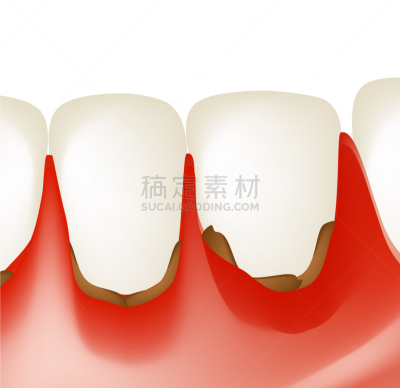 齿龈炎,人的牙齿,炎症,口腔卫生,信息图表,健康保健,人,珐琅,牙医,生病