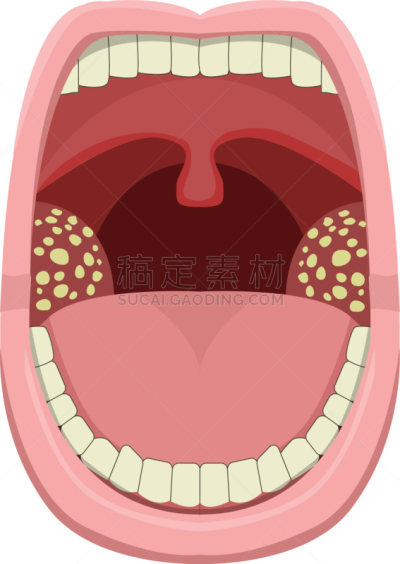 炎症,扁桃腺炎,计划书,咽炎,扁桃体,肿胀的,健康保健,人,生病