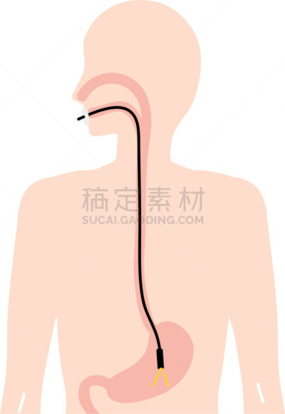 绘画插图,检查,代表,平衡折角灯,粘液,健康保健,癌症,粘膜,医疗流程,医疗图