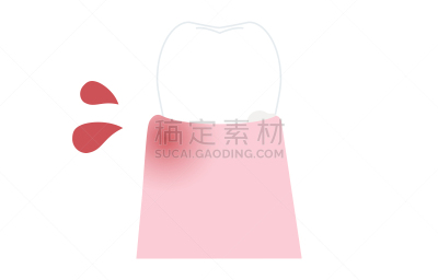 绘画插图,牙周病,早晨,舞台,肿胀的,口腔卫生,健康保健,龋齿,生物膜生物,牙医