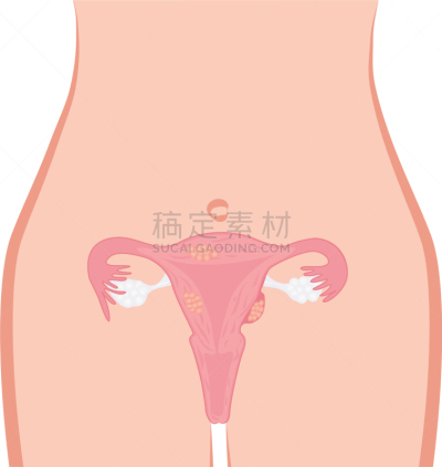宫颈巴氏涂片,子宫颈,健康保健,人,图表,有月经,图像,女人,生病